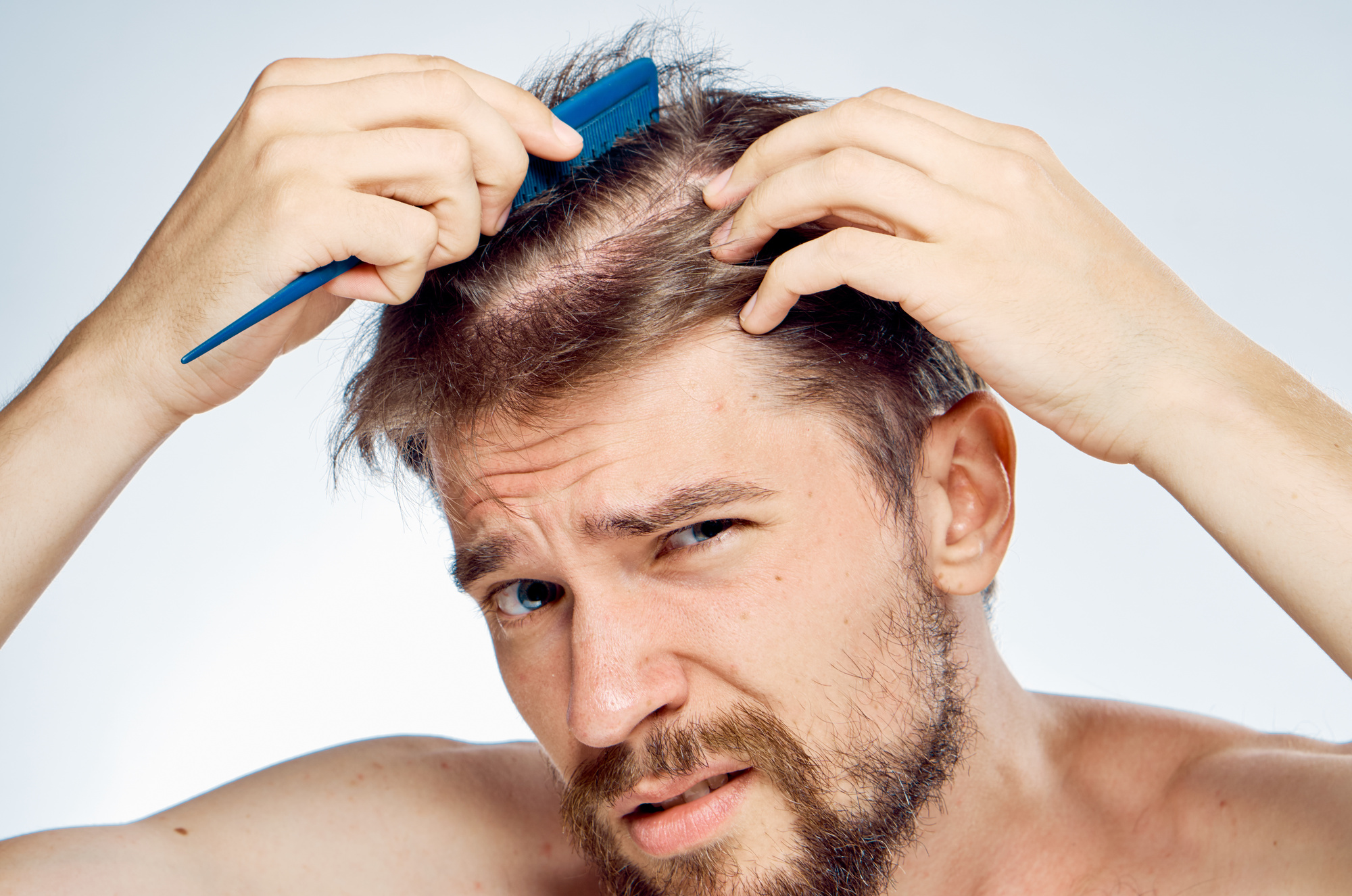 These Are the Different Types of Hair Loss » Trending Us