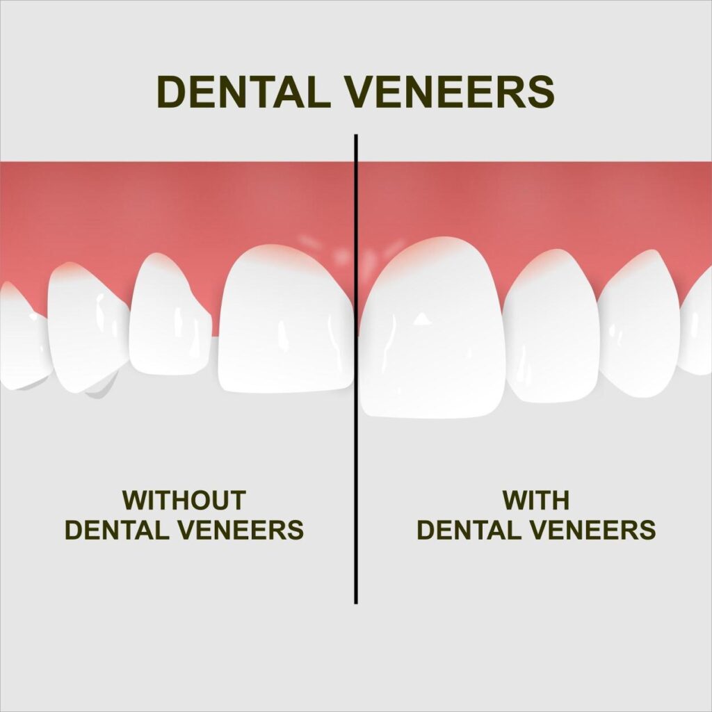 Dental veneers