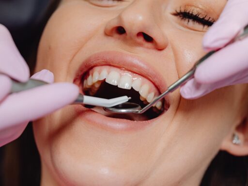 Hollywood smile treatment